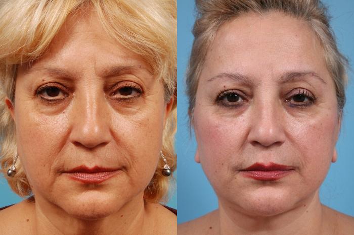 Before & After Midface Lift by Dr. Mustoe Case 23 Front View in Chicago, IL