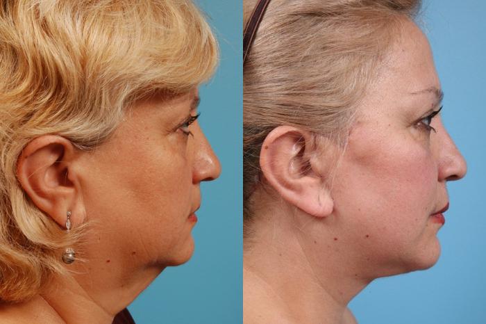 Before & After Neck Lift by Dr. Mustoe Case 23 Right Side View in Chicago, IL