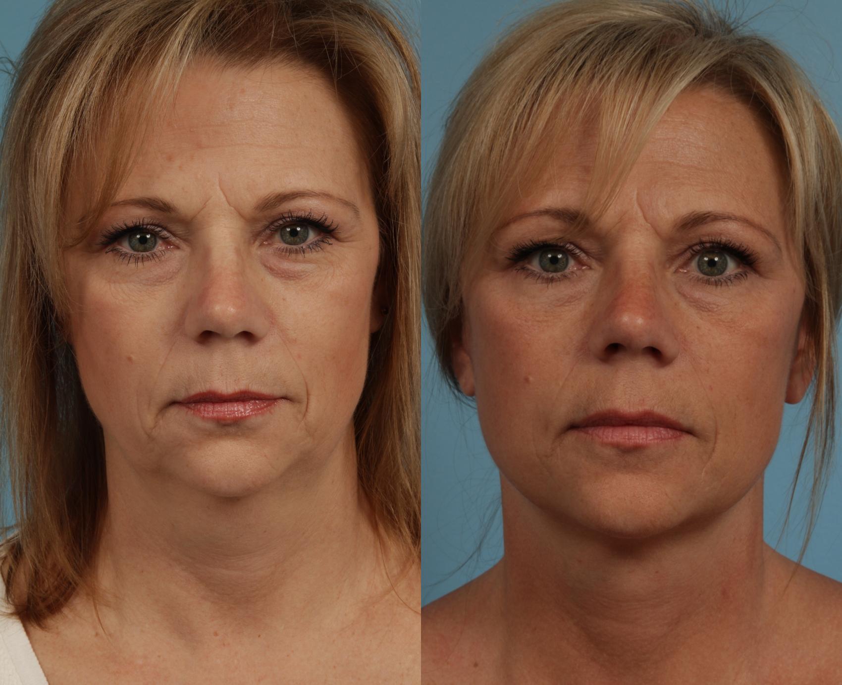 Before & After Facelift/Minilift by Dr. Mustoe Case 274 Front View in Chicago, IL