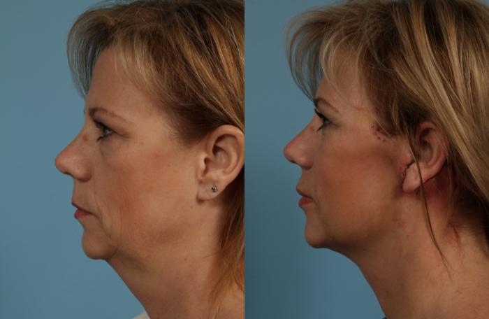 Before & After Facelift/Minilift by Dr. Mustoe Case 274 Left Side View in Chicago, IL