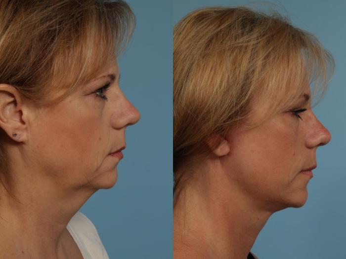 Before & After Facelift/Minilift by Dr. Mustoe Case 274 View #4 View in Chicago, IL