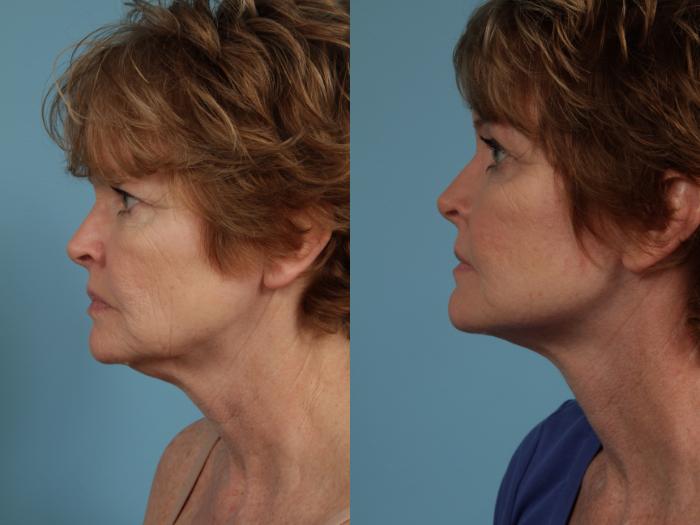 Before & After Facelift/Minilift by Dr. Mustoe Case 285 View #3 View in Chicago, IL