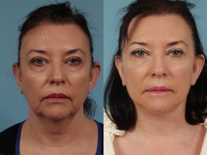 Before & After Facelift/Minilift by Dr. Mustoe Case 329 View #1 View in Chicago, IL