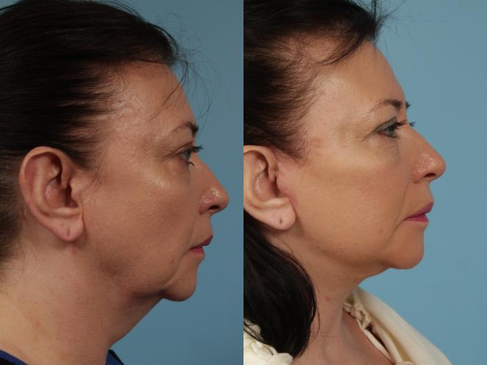 Before & After Facelift/Minilift by Dr. Mustoe Case 329 View #3 View in Chicago, IL