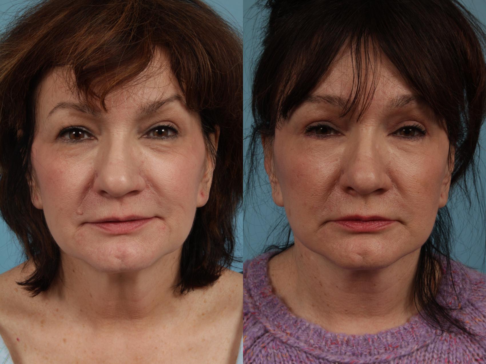 Before & After Facelift/Minilift by Dr. Mustoe Case 335 View #1 View in Chicago, IL