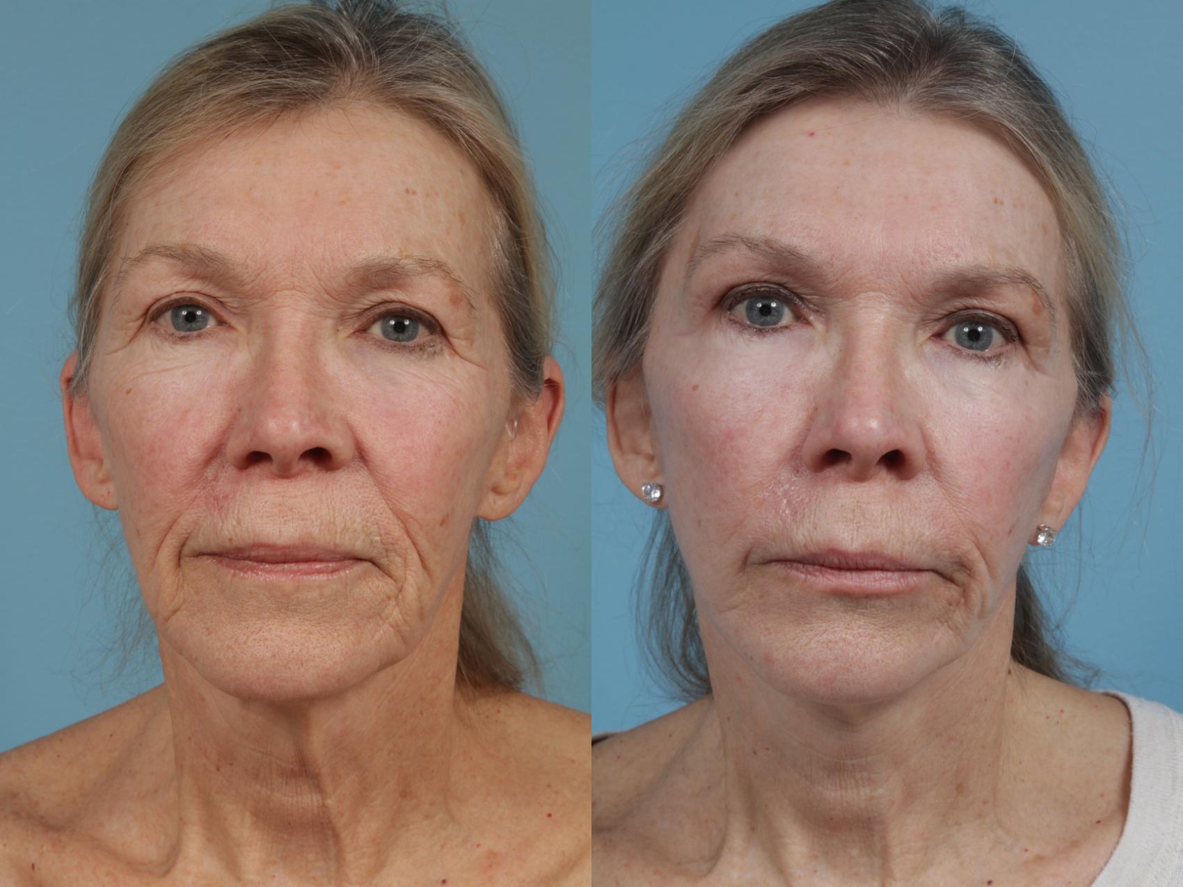 Mini Facelift In Chicago | TLKM Plastic Surgery