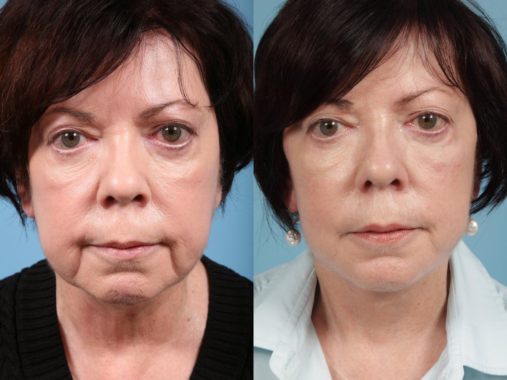 Before & After Neck Lift by Dr. Mustoe Case 40 Front View in Chicago, IL