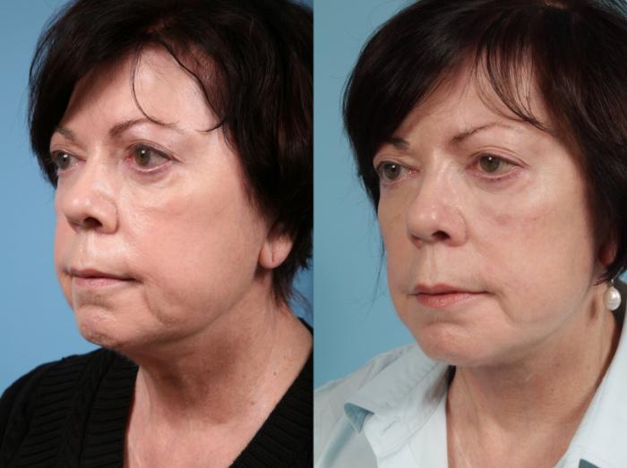Before & After Midface Lift by Dr. Mustoe Case 40 Left Oblique View in Chicago, IL
