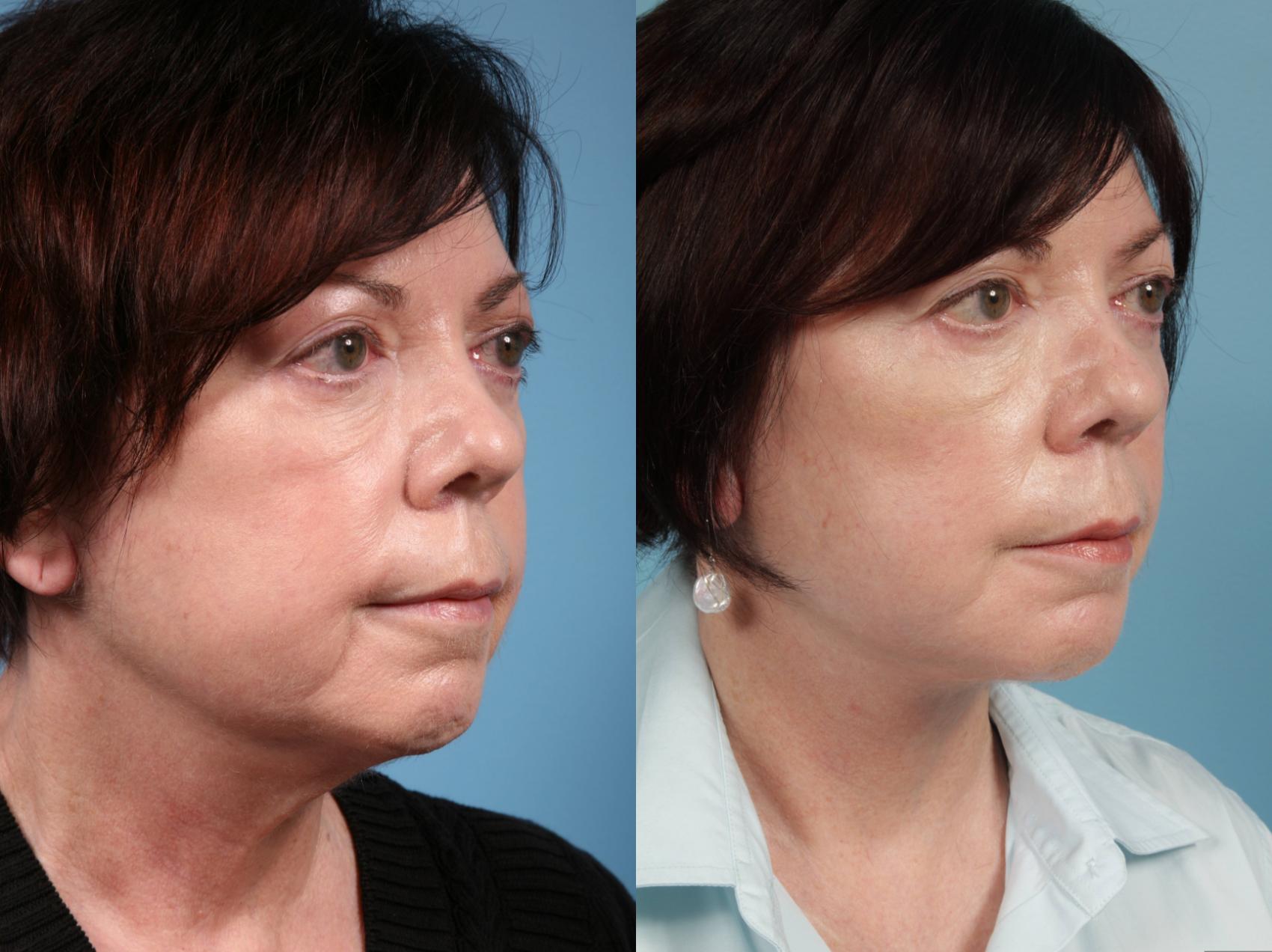 Before & After Fat Grafting by Dr. Mustoe Case 40 Right Oblique View in Chicago, IL