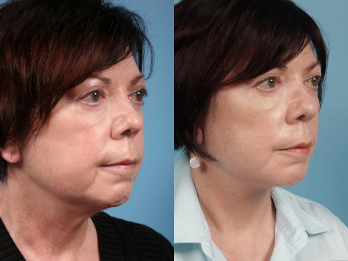 Before & After Neck Lift by Dr. Mustoe Case 40 Right Oblique View in Chicago, IL