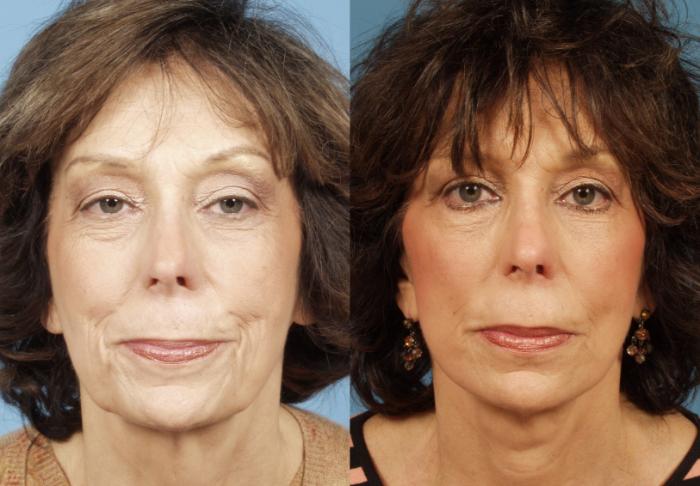 Before & After Neck Lift by Dr. Mustoe Case 41 Front View in Chicago, IL