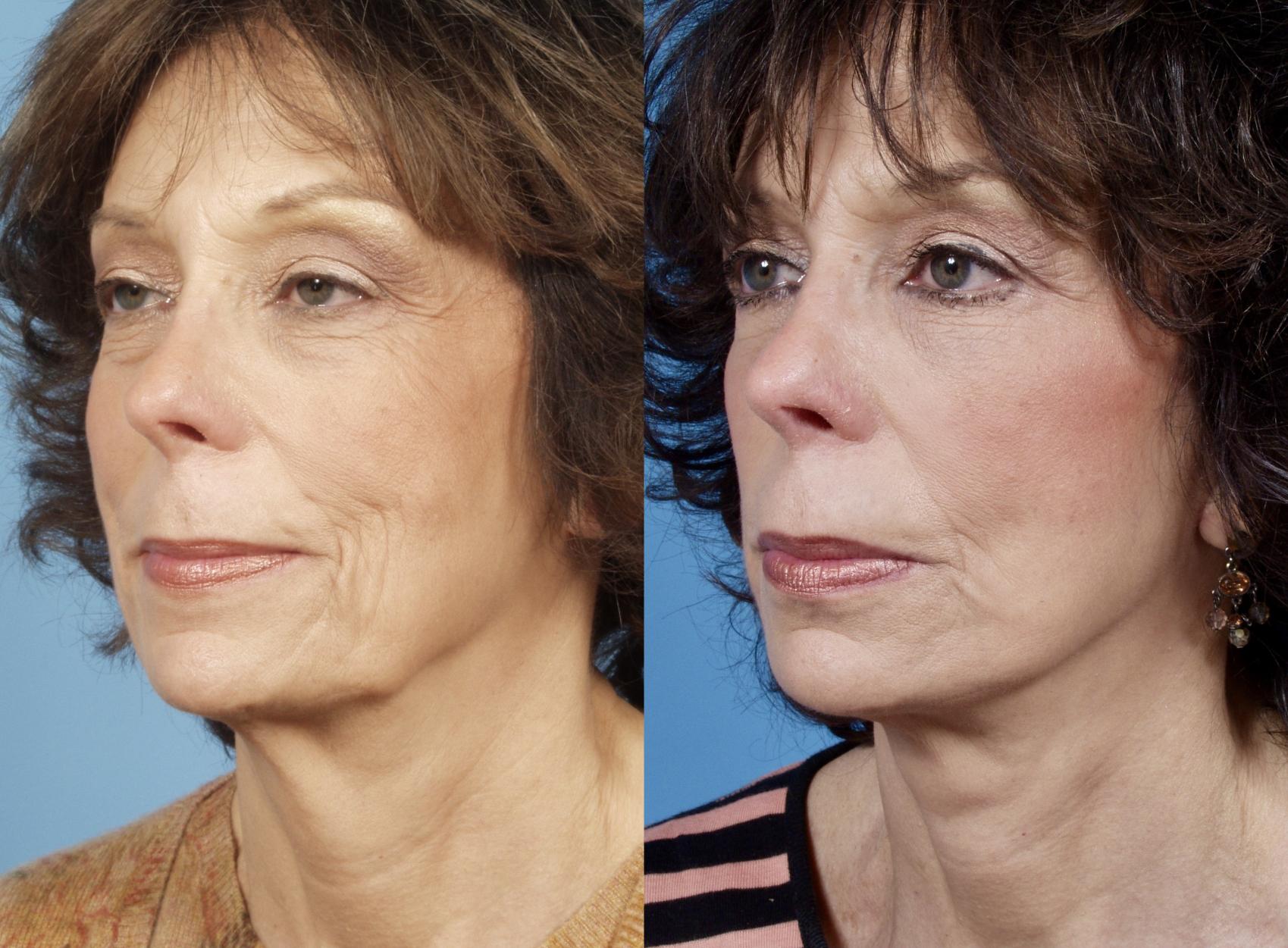 Before & After Neck Lift by Dr. Mustoe Case 41 Left Oblique View in Chicago, IL