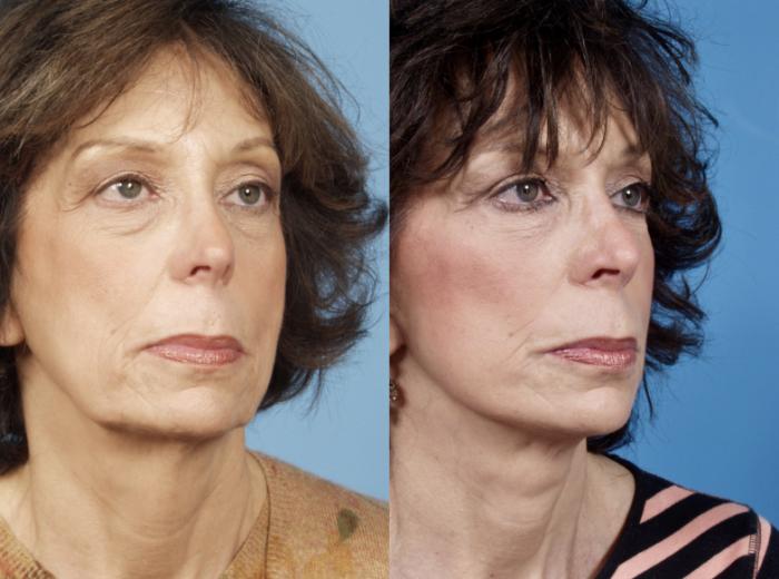Before & After Midface Lift by Dr. Mustoe Case 41 Right Oblique View in Chicago, IL