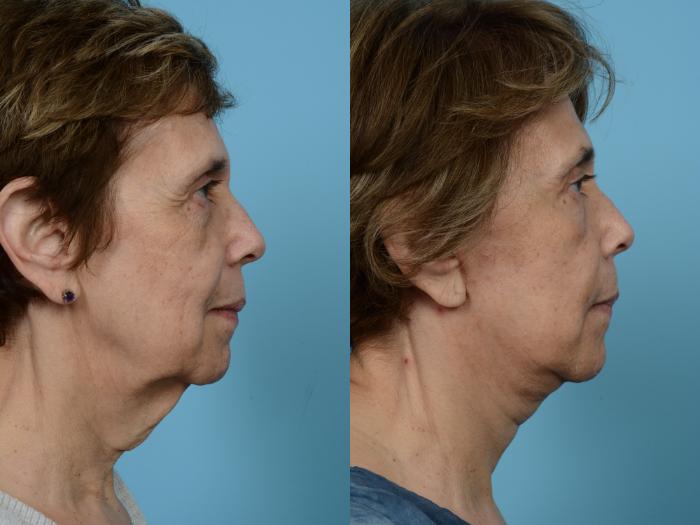 Before & After Facelift/Minilift by Dr. Mustoe Case 465 View #3 View in Chicago, IL
