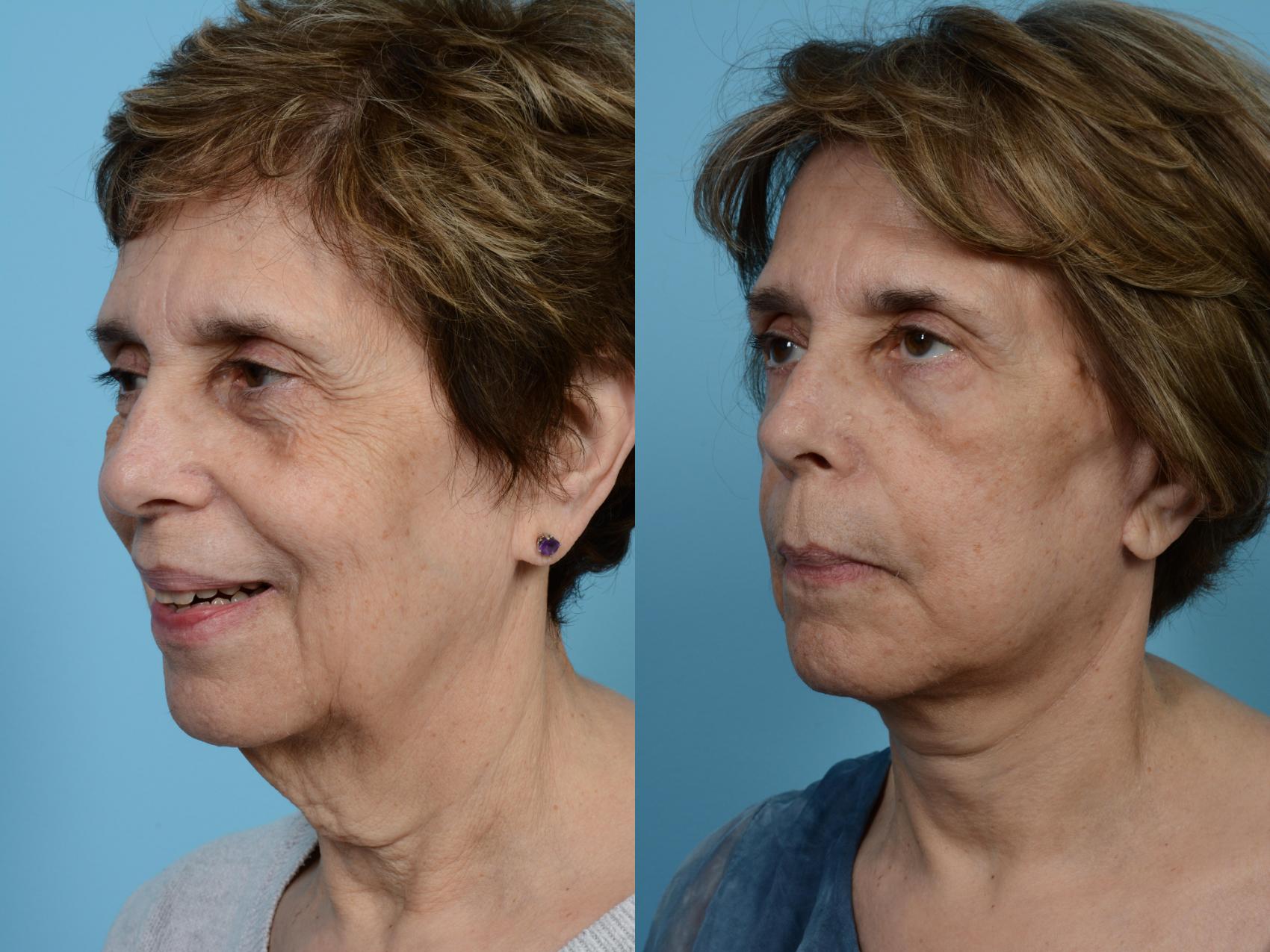 Before & After Facelift/Minilift by Dr. Mustoe Case 467 View #1 View in Chicago, IL