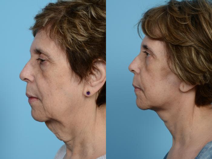 Before & After Facelift/Minilift by Dr. Mustoe Case 467 View #2 View in Chicago, IL