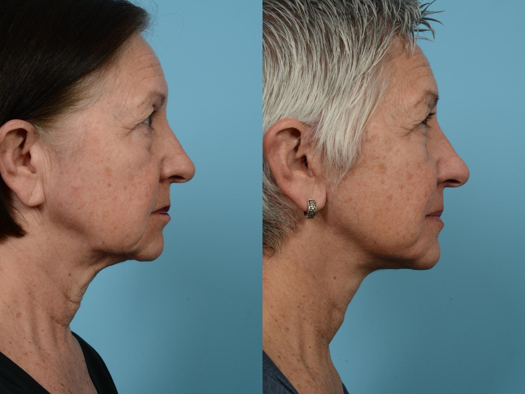 Before & After Facelift/Minilift by Dr. Mustoe Case 569 View #3 View in Chicago, IL