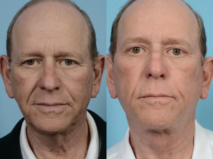 Before & After Neck Lift by Dr. Mustoe Case 570 Front View in Chicago, IL