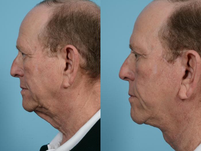 Before & After Neck Lift by Dr. Mustoe Case 570 Left Side View in Chicago, IL