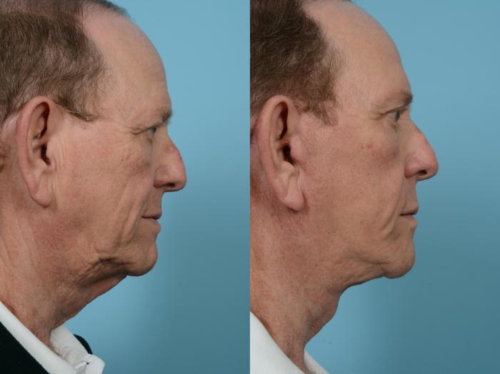 Before & After Neck Lift by Dr. Mustoe Case 570 Right Side View in Chicago, IL