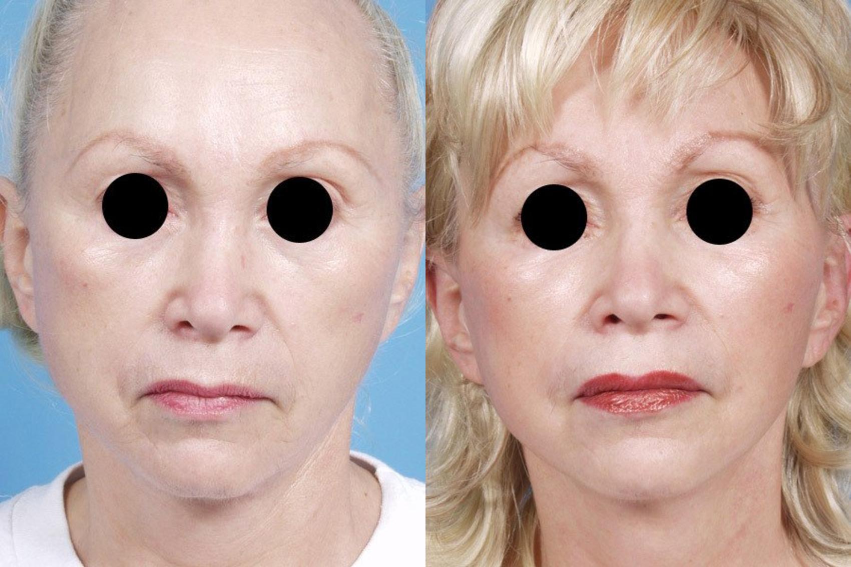 Before & After Facelift/Minilift by Dr. Mustoe Case 6 View #1 View in Chicago, IL