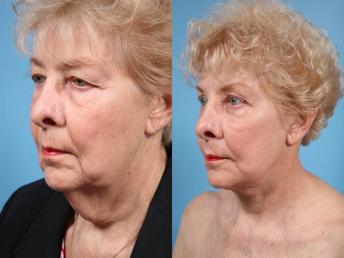 Before & After Facelift/Minilift by Dr. Mustoe Case 69 View #1 View in Chicago, IL