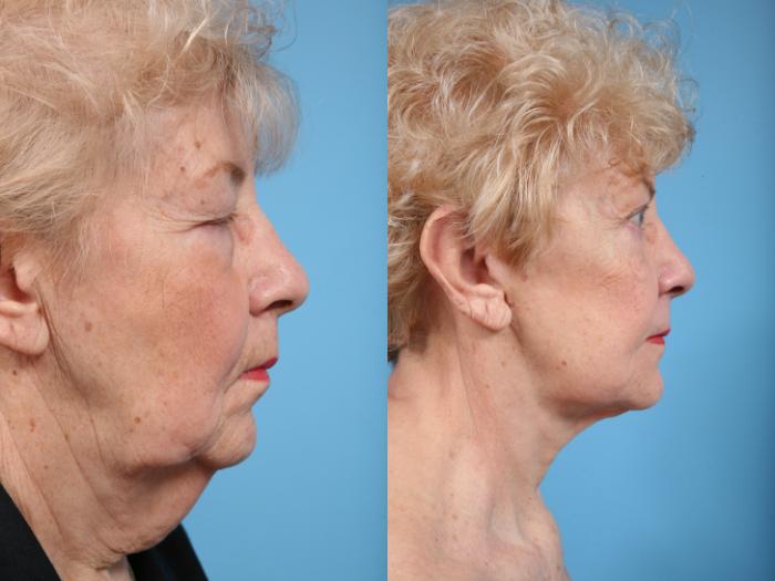 Before & After Midface Lift by Dr. Mustoe Case 69 View #5 View in Chicago, IL