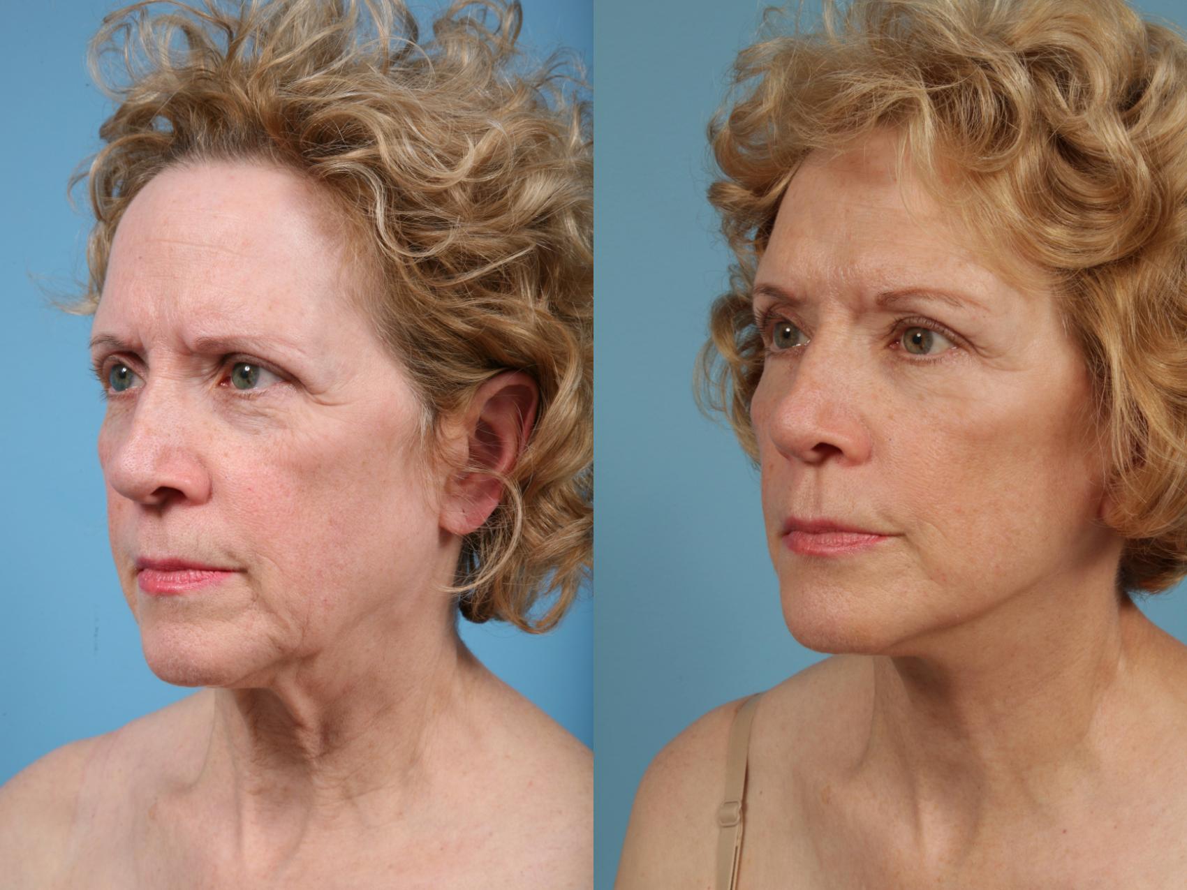 Before & After Facelift/Minilift by Dr. Mustoe Case 76 View #1 View in Chicago, IL