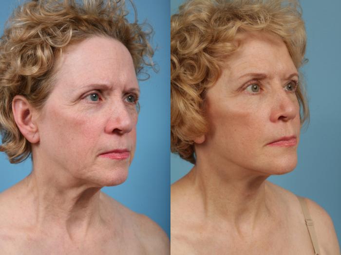 Before & After Facelift/Minilift by Dr. Mustoe Case 76 View #2 View in Chicago, IL