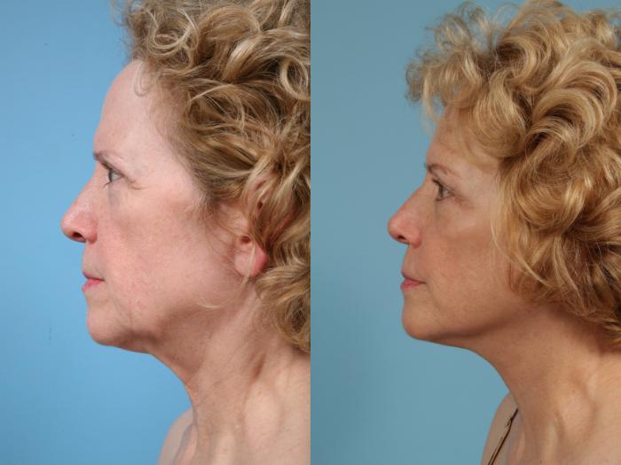Before & After Facelift/Minilift by Dr. Mustoe Case 76 View #3 View in Chicago, IL