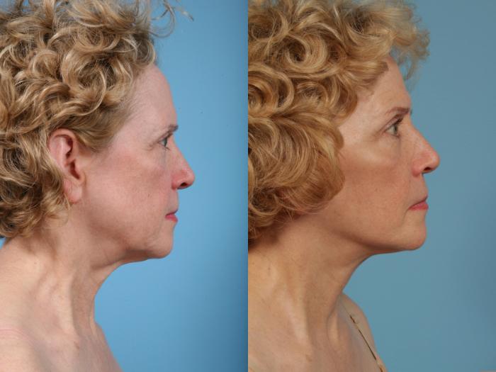 Before & After Facelift/Minilift by Dr. Mustoe Case 76 View #4 View in Chicago, IL