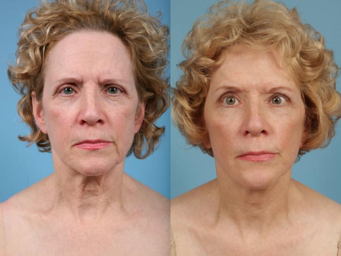 Before & After Facelift/Minilift by Dr. Mustoe Case 76 View #5 View in Chicago, IL
