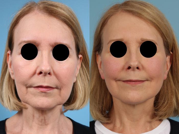 Before & After Facelift/Minilift by Dr. Mustoe Case 77 View #1 View in Chicago, IL