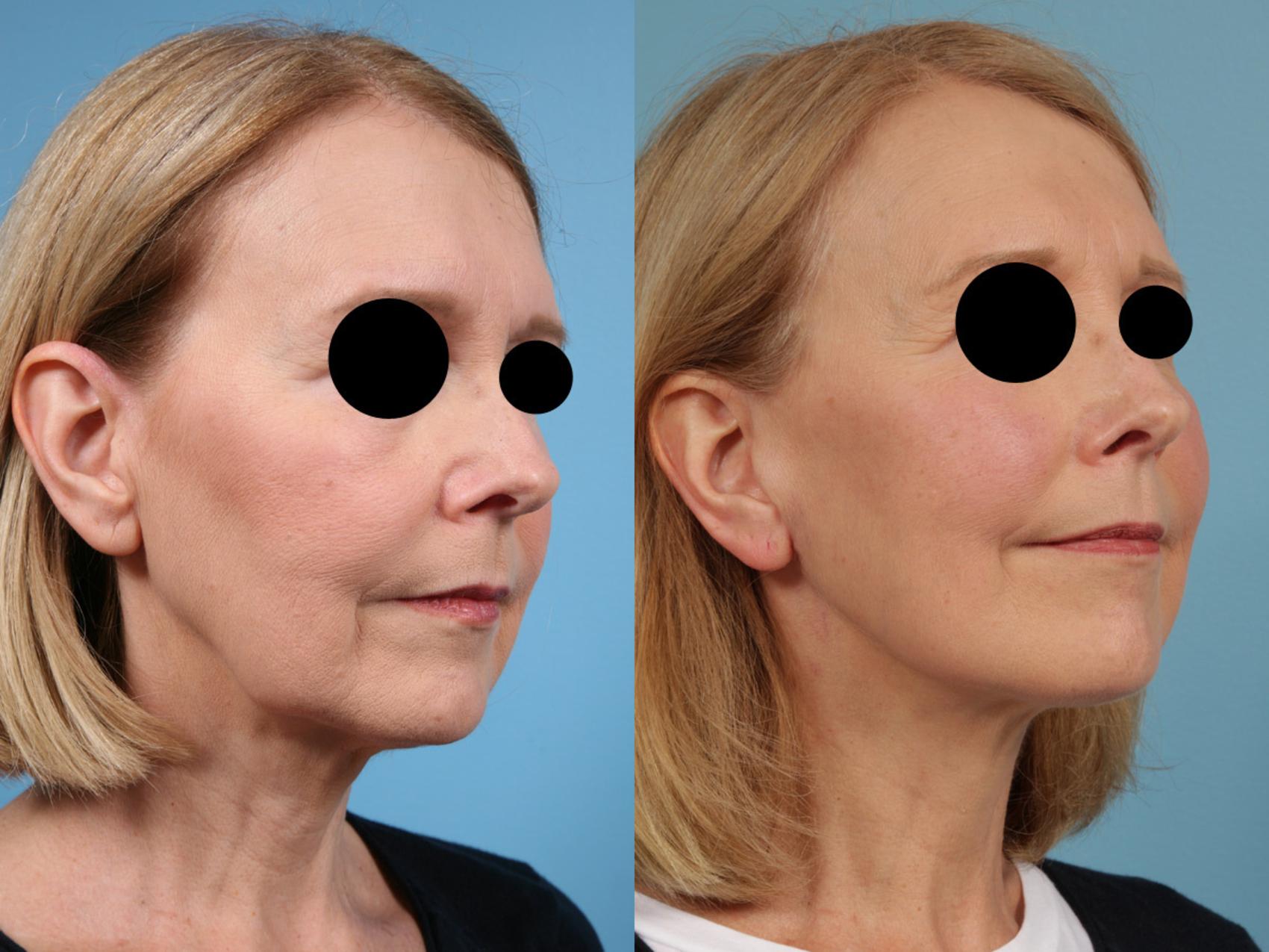 Before & After Deep Plane Facelift by Dr. Mustoe Case 77 View #2 View in Chicago, IL