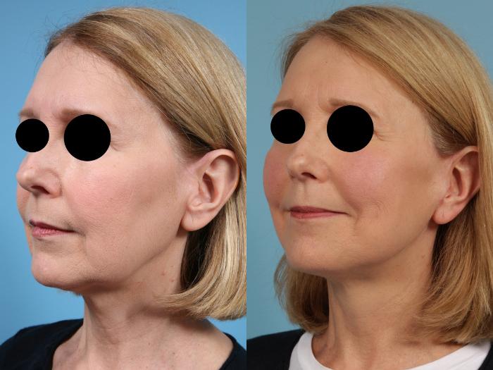 Before & After Facelift/Minilift by Dr. Mustoe Case 77 View #3 View in Chicago, IL