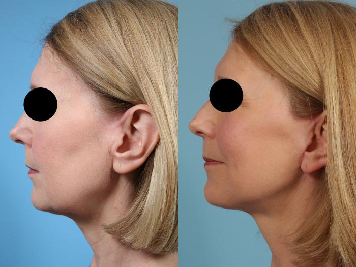 Before & After Facelift/Minilift by Dr. Mustoe Case 77 View #4 View in Chicago, IL
