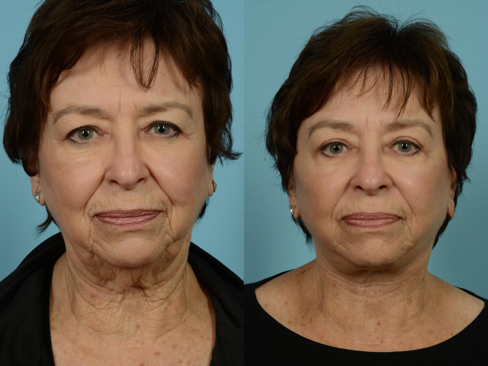 Before & After Neck Lift by Dr. Mustoe Case 770 Front View in Chicago, IL