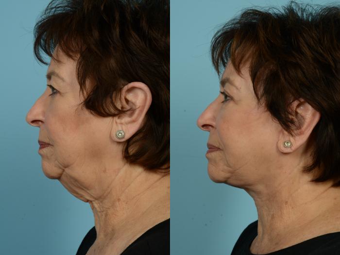 Before & After Neck Lift by Dr. Mustoe Case 770 Left Side View in Chicago, IL