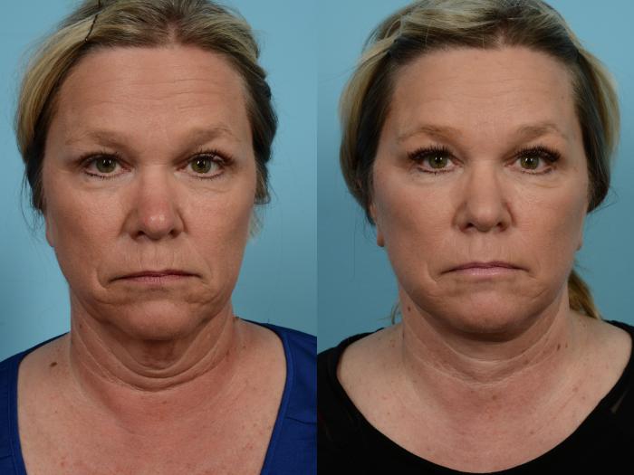 Before & After Facelift/Minilift by Dr. Mustoe Case 771 Front View in Chicago, IL
