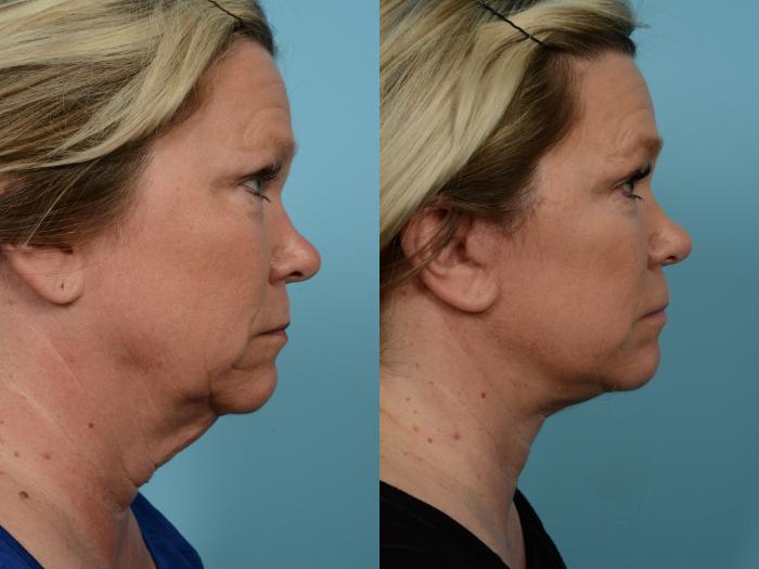 Before & After Midface Lift by Dr. Mustoe Case 771 Right Side View in Chicago, IL