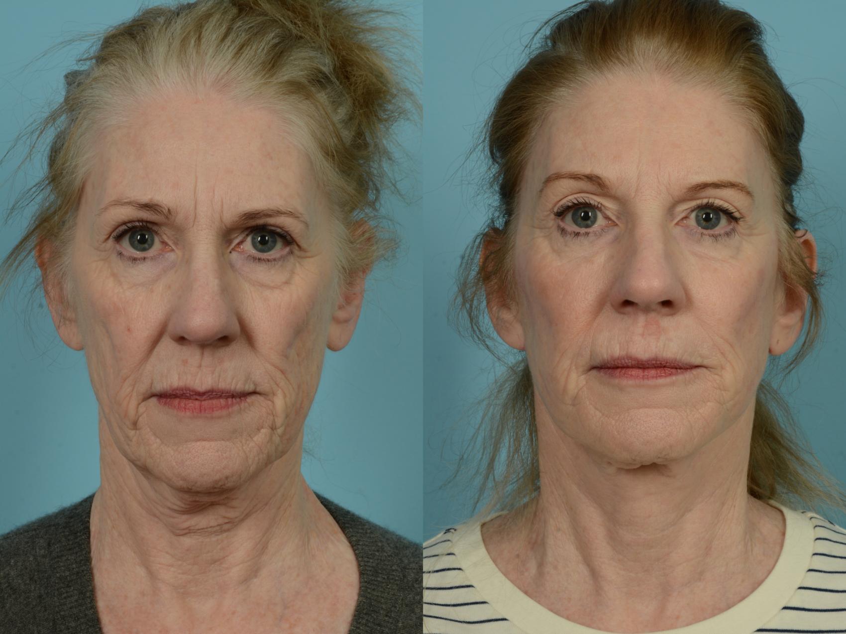 Before & After Facelift/Minilift by Dr. Mustoe Case 834 Front View in Chicago, IL
