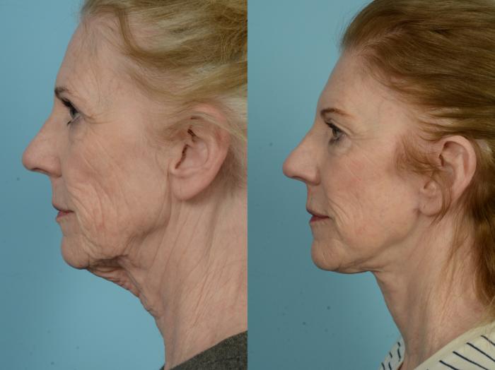 Before & After Facelift/Minilift by Dr. Mustoe Case 834 Left Side View in Chicago, IL