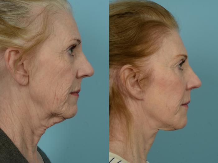 Before & After Facelift/Minilift by Dr. Mustoe Case 834 Right Side View in Chicago, IL