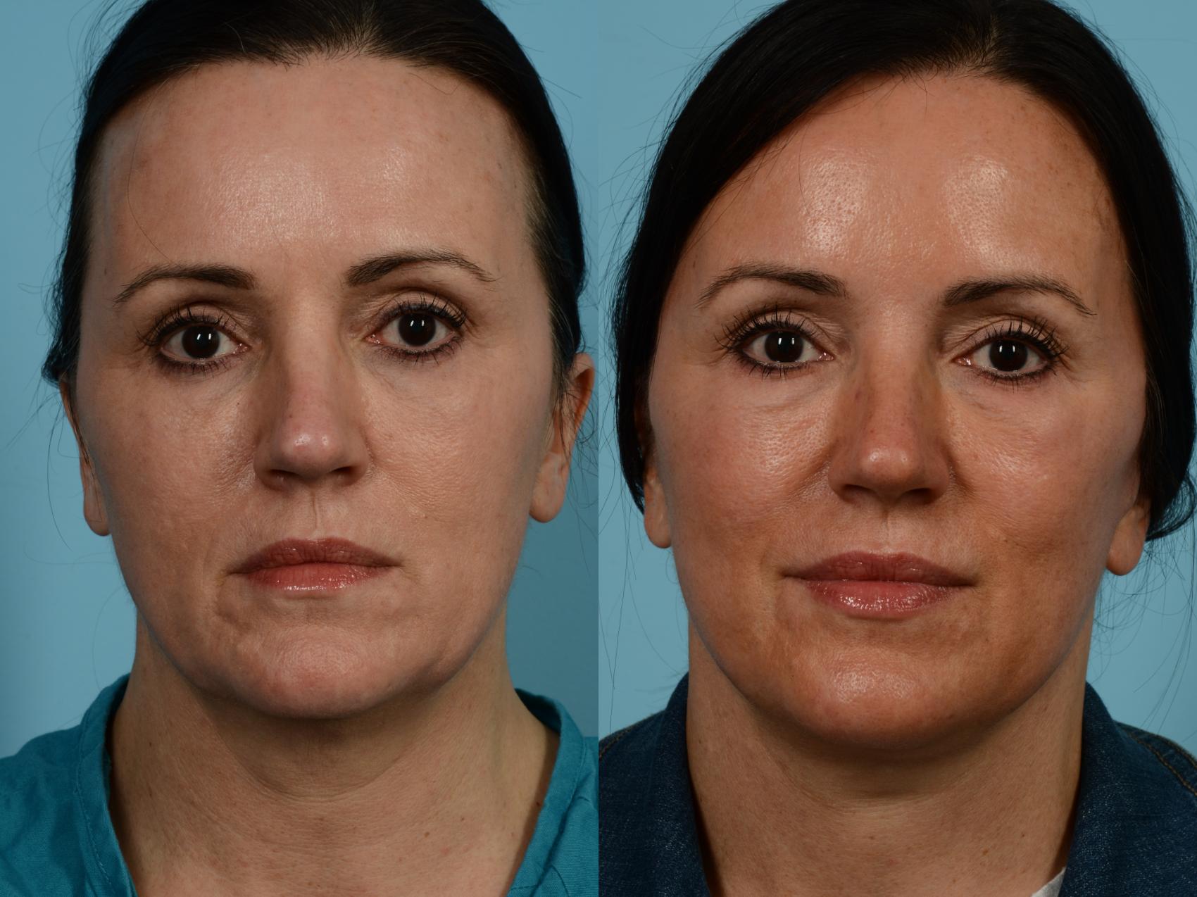 Before & After Deep Plane Facelift by Dr. Mustoe Case 841 Front View in Chicago, IL
