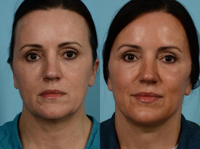 Before & After Facelift/Minilift by Dr. Mustoe Case 841 Front View in Chicago, IL