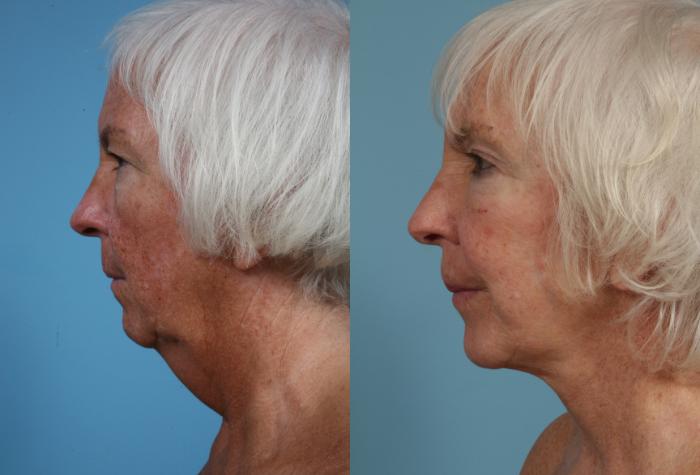 Before & After Facelift/Minilift by Dr. Mustoe Case 87 Left Side View in Chicago, IL