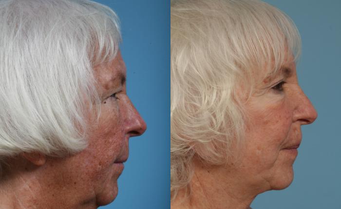 Before & After Facelift/Minilift by Dr. Mustoe Case 87 Right Side View in Chicago, IL