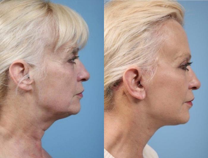 Before & After Facelift/Minilift by Dr. Mustoe Case 889 Right Side View in Chicago, IL