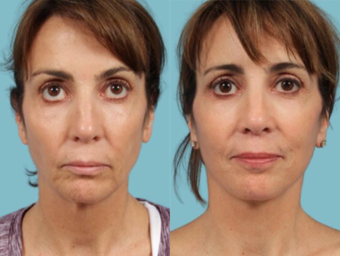 Before & After Facelift/Minilift by Dr. Mustoe Case 924 Front View in Chicago, IL