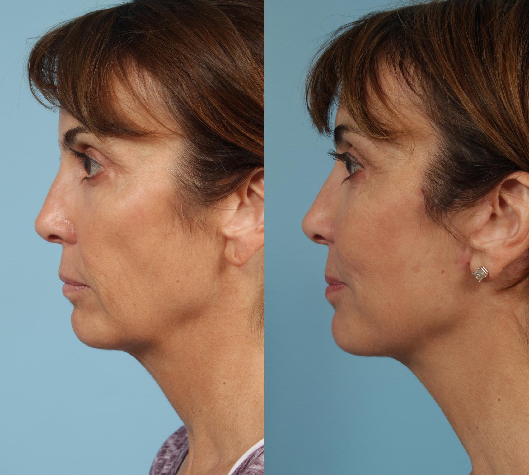 Before & After Deep Plane Facelift by Dr. Mustoe Case 924 Left Side View in Chicago, IL